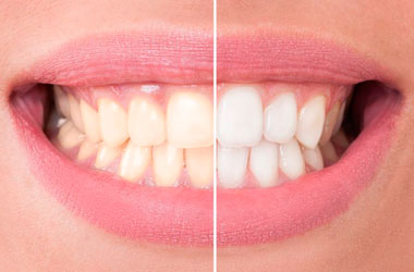 Clareamento Dental