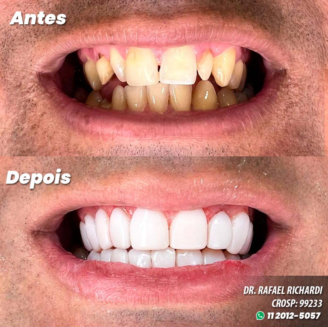 Facetas em Resina Antes e Depois - Dr. Glicério