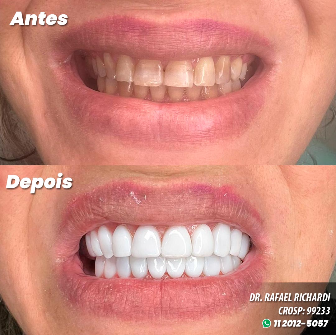 Facetas em Resina Antes e Depois - Dr. Glicério