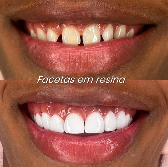 Facetas em Resina Antes e Depois - Dr. Glicério