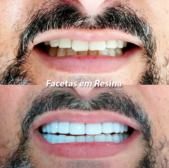 Facetas em Resina Antes e Depois - Dr. Glicério