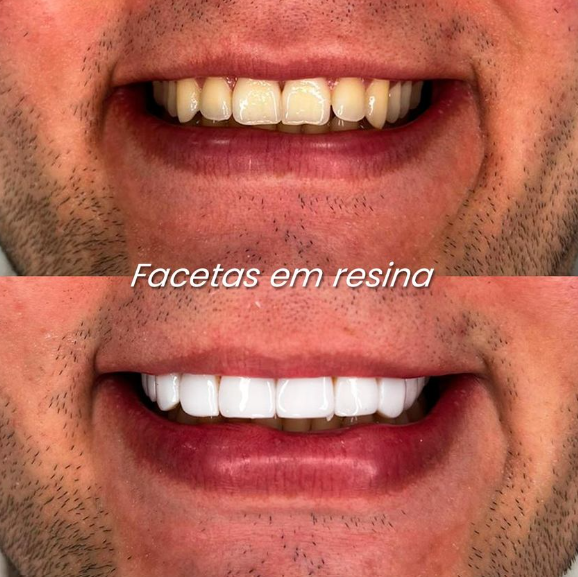 Facetas em Resina Antes e Depois - Dr. Glicério